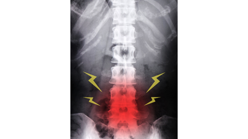 腰椎分離症復帰プログラム 腰椎X線画像